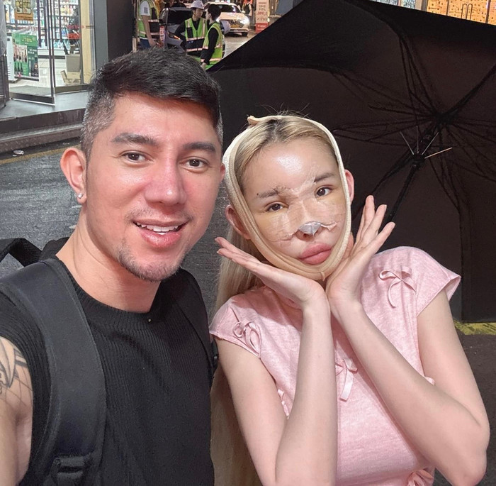 Ngân 98 tiếp tục thẩm mỹ để trùng tu nhan sắc.