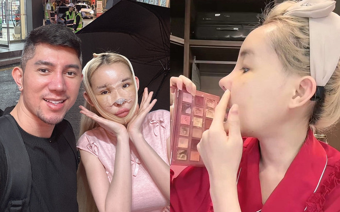 Nhan sắc Ngân 98 sau khi tháo nẹp mũi 'đập mặt xây lại' Ảnh 2