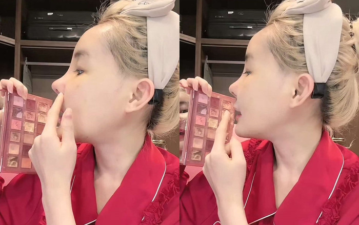 Diện mạo của Ngân 98 sau khi tháo băng nẹp mũi.