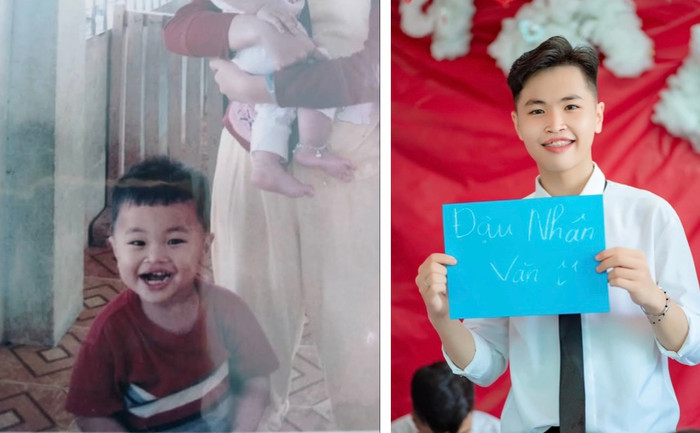 Gương mặt hiện tại của Lộc đã thay đổi khi trải qua 3 cuộc phẫu thuật trong suốt 18 năm.