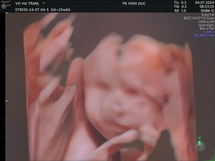 Võ Hạ Trâm khoe cận ảnh siêu âm nhóc tỳ thứ 2.