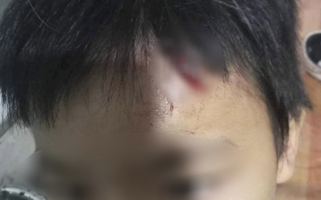 Bé trai 10 tuổi nghi bị mẹ kế tiếp tục bạo hành Ảnh 2