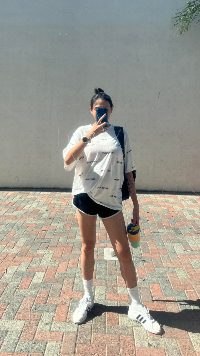 Võ Hoàng Yến khiến fans lo lắng với đôi chân đầy vết đốm đen. Ảnh FBNV