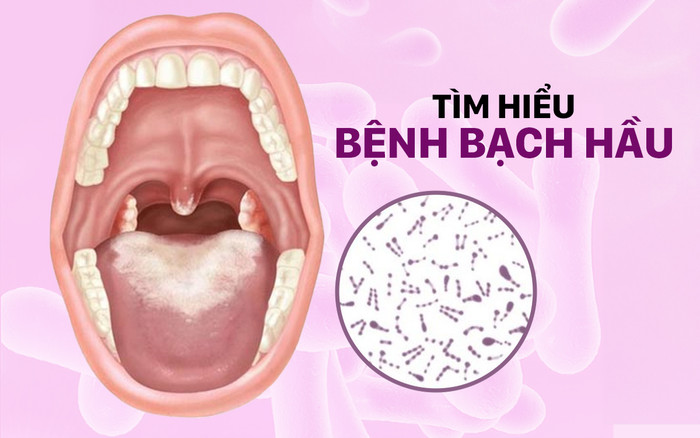 Cô gái 18 tuổi tử vong do bệnh bạch hầu: Tất tần tật về căn bệnh này Ảnh 2