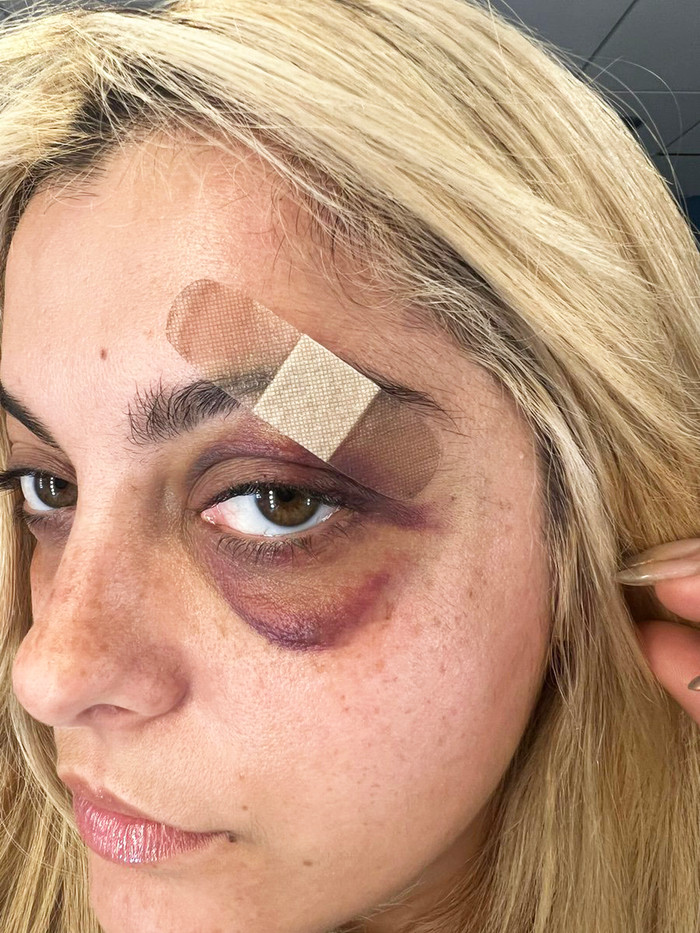 Sự cố bị khán giả ném điện thoại vào mặt trong lúc biểu diễn đã khiến BeBe Rexha khâu bau mũi.