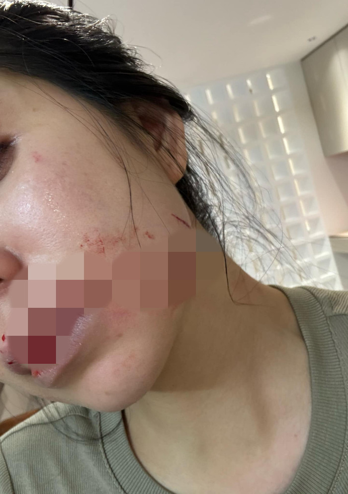Những vết thương trên mặt và miệng của Hằng Du Mục do bị chồng tấn công
