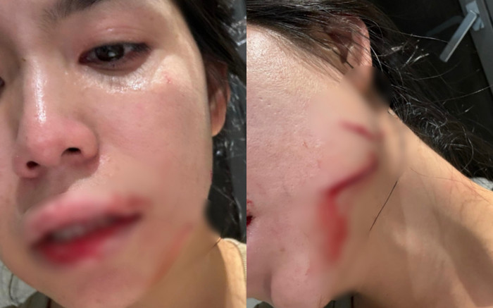 Hàng loạt thương tích của Hằng Du Mục đã được kiểm tra, kết quả bất ngờ Ảnh 2