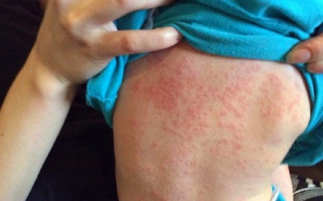 TP.HCM ghi nhận 3 trẻ tử vong do sởi Ảnh 2