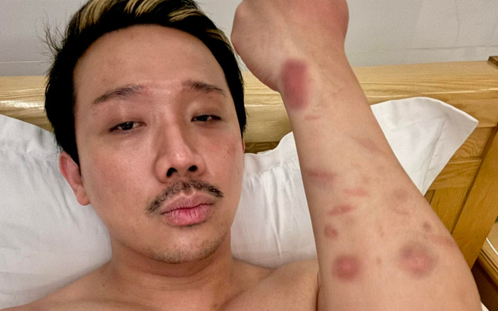 Trấn Thành bị thương tích đầy mình Ảnh 2