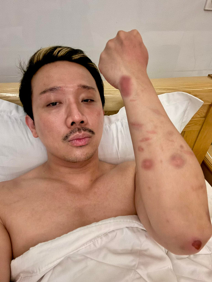 Trấn Thành gây lo lắng với đôi tay chi chít vết thương. Ảnh: FBNV