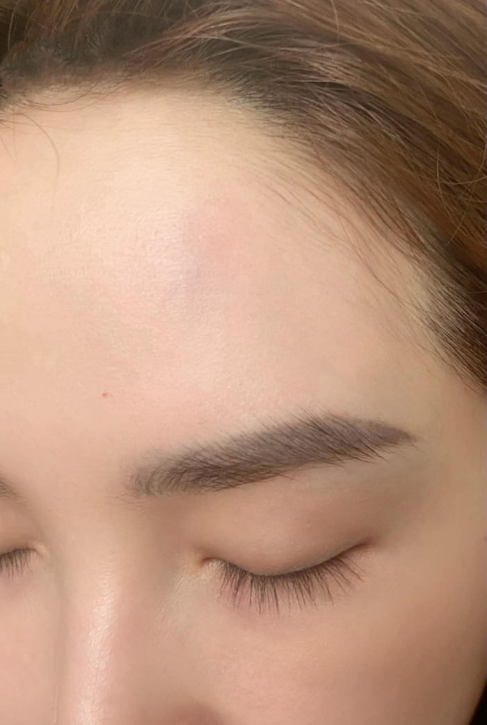 Bảo Thy khoe thương tích vì va chạm với con trai. 