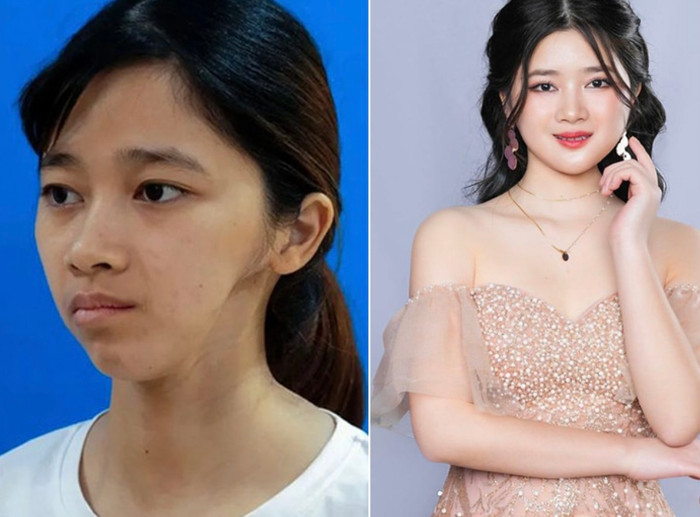 Ninh Thị Thu Hường trước và sau phẫu thuật, màn lột xác khiến ai cũng bất ngờ.