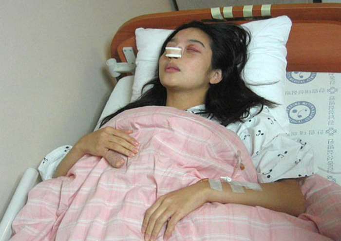 Hình ảnh của Lee Min Young tại bệnh viện sau khi bị chồng hành hung.