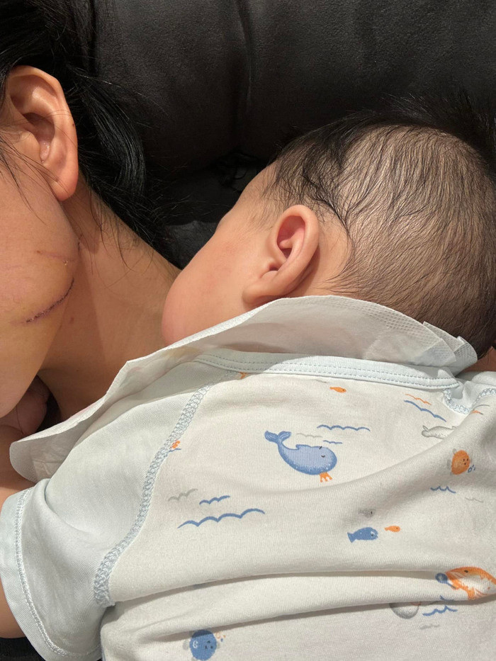 Vết thương của Hằng Du Mục do bị chồng bạo hành tuy đã khô nhưng vẫn chưa lành hẳn.