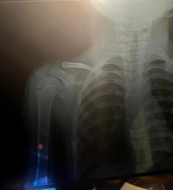 Hình ảnh chụp X-quang của con gái được bà xã Bùi Tiến Dũng chia sẻ. 