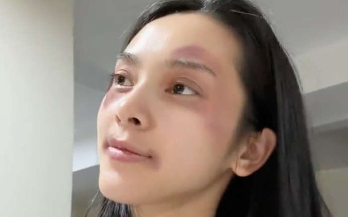 Quỳnh Lương tố bị bạn trai thiếu gia 'tác động vật lý', mắt bầm tím? Ảnh 2