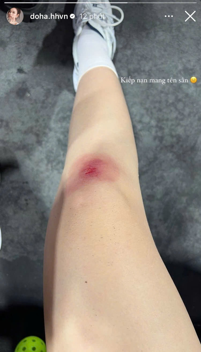 Đỗ Thị Hà bị thương ở chân do té ngã trong việc tập luyện Pickleball.