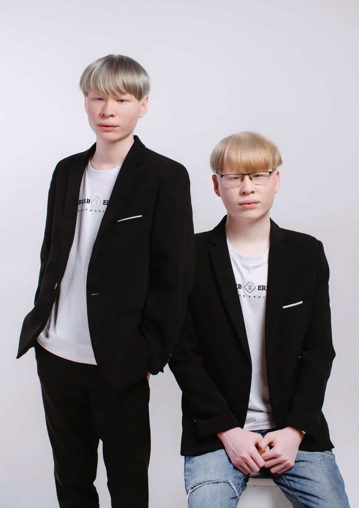 Hiện tại cặp song sinh bạch tạng không còn cảm thấy tự ti về ngoại hình