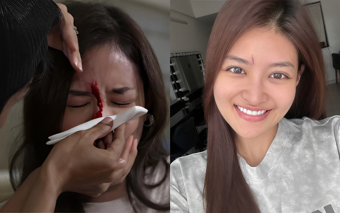 Nữ diễn viên Việt bị rách mặt, phải khâu 6 mũi.