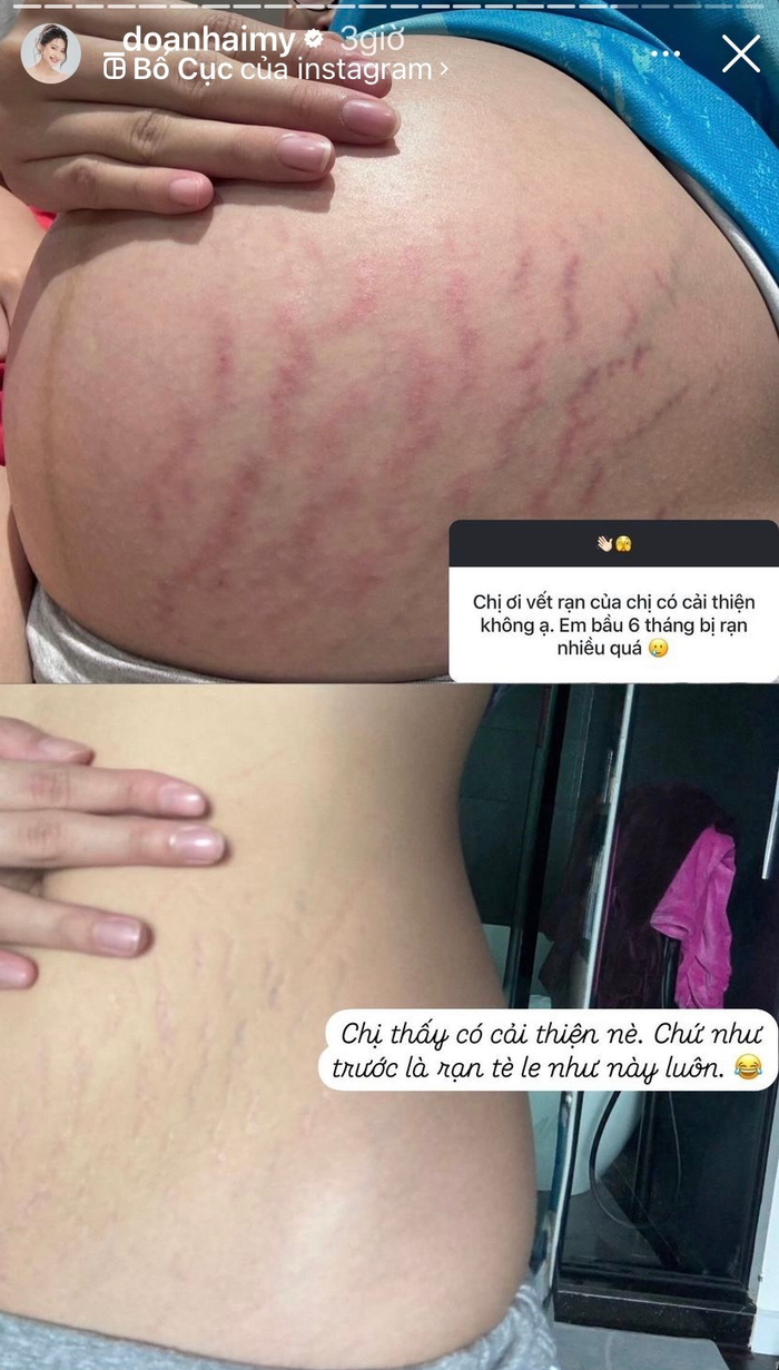 Vợ Đoàn Văn Hậu chia sẻ về tình trạng rạn da sau sinh. Ảnh chụp màn hình