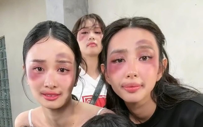 Thùy Tiên để lộ gương mặt có chi chít vết bầm tím Ảnh 2