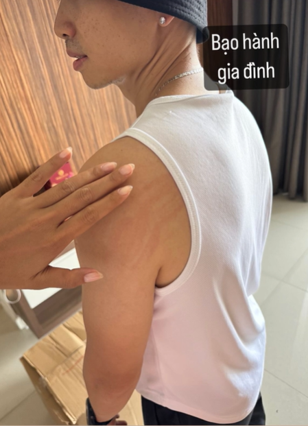 Bạn trai H'Hen Niê chia sẻ hình ảnh bị ai đó 'tác động vật lý'.