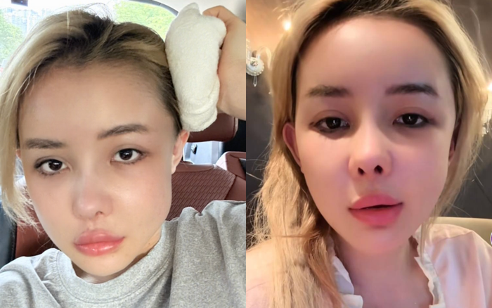 Ngân 98 buồn bã vì khuôn mặt biến dạng. Ảnh: Chụp màn hình