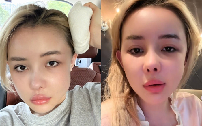 Khuôn mặt của Ngân 98 bị sưng méo hậu can thiệp 'dao kéo' Ảnh 2