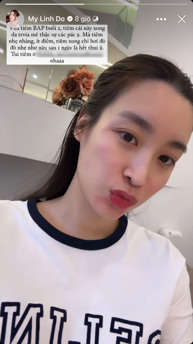 Hoa hậu Đỗ Mỹ Linh hài lòng về độ hiệu quả của phương pháp tiêm BAP.