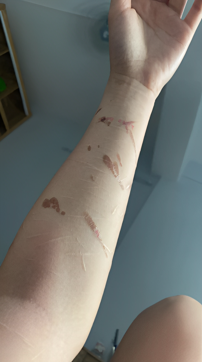 Cận cảnh những vết sẹo dài là kết quả của những tổn thương tinh thần trong quá khứ của Thu Hà Ceri. 