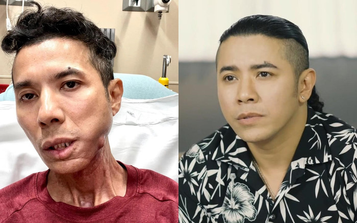 Kasim Hoàng Vũ đang mắc bệnh gì mà gây lệch mặt, sụt 15kg, đau không chịu nổi? Ảnh 2