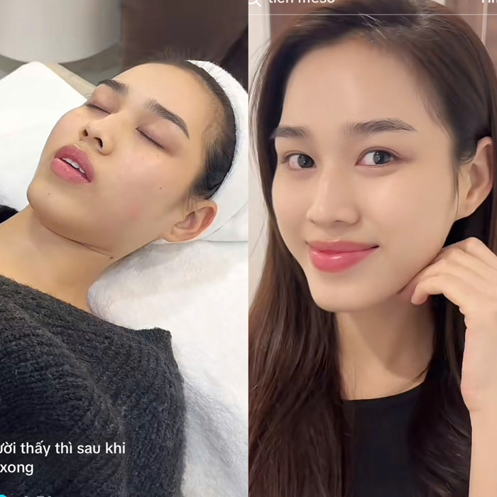 Da của Hoa hậu Đỗ Thị Hà có sự thay đổi rõ rệt sau 7 ngày tiêm meso. 