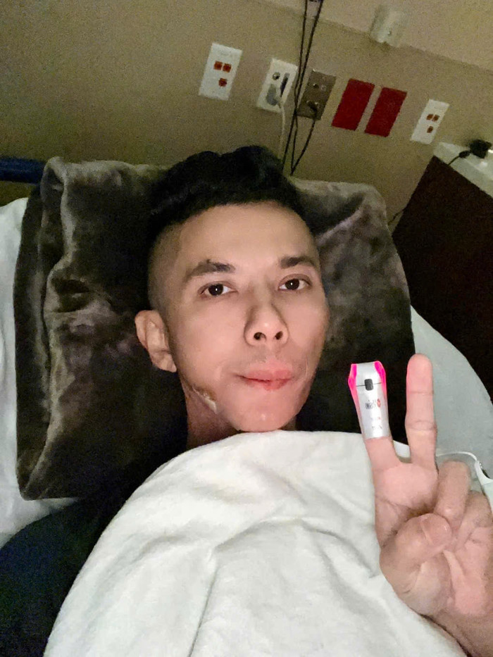 Kasim Hoàng Vũ cho biết bị viêm khớp xương hàm, sau đó phải phẫu thuật nang xương ở hàm và cổ dẫn đến gương mặt khác lạ so với trước đây. 