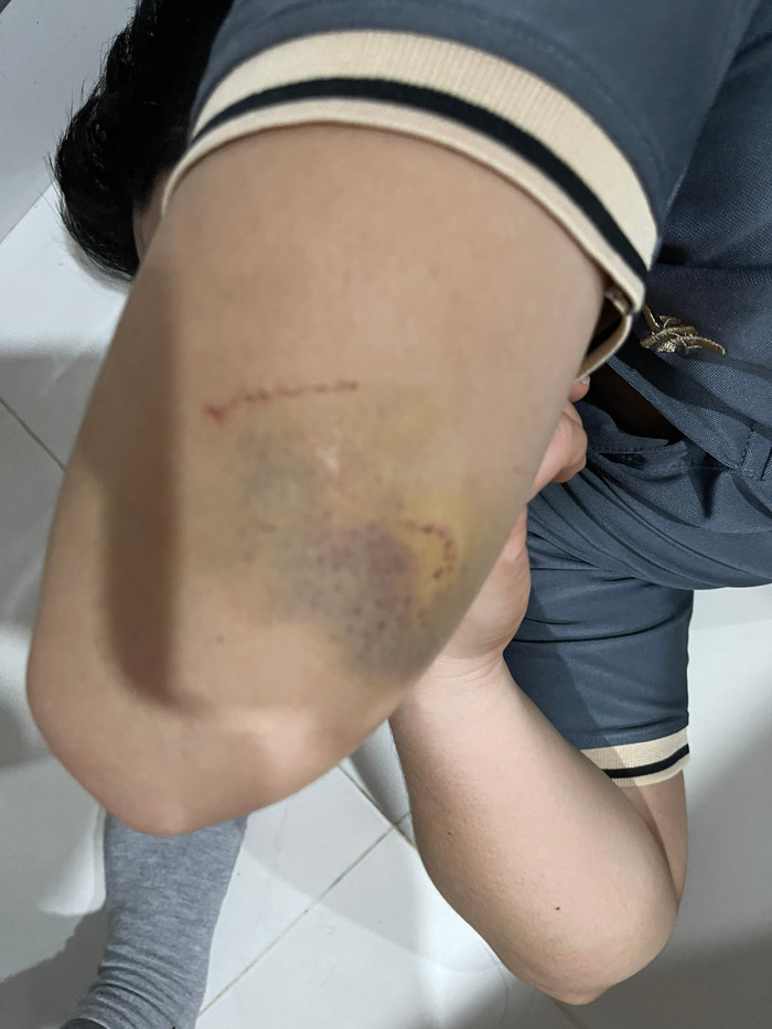 Tay anh Hậu cũng bị bầm tím trong quá trình can ngăn người phụ nữ đánh người vợ đang mang thai của mình