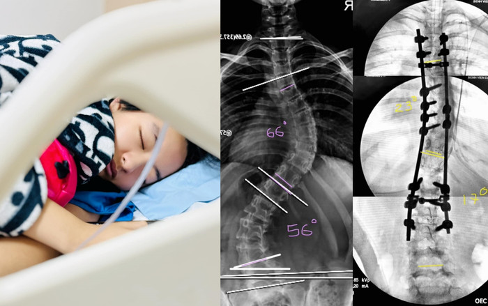 Kết quả trước và sau phẫu thuật cột sống của con gái Thúy Hằng.