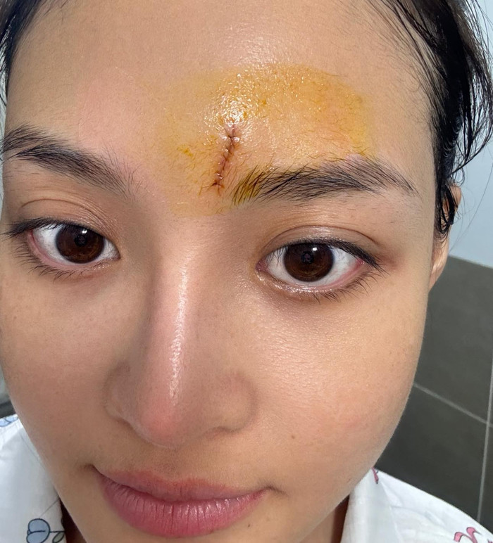 Thùy Anh phải khâu ngay trên trán vì gặp sự cố ở phim trường.