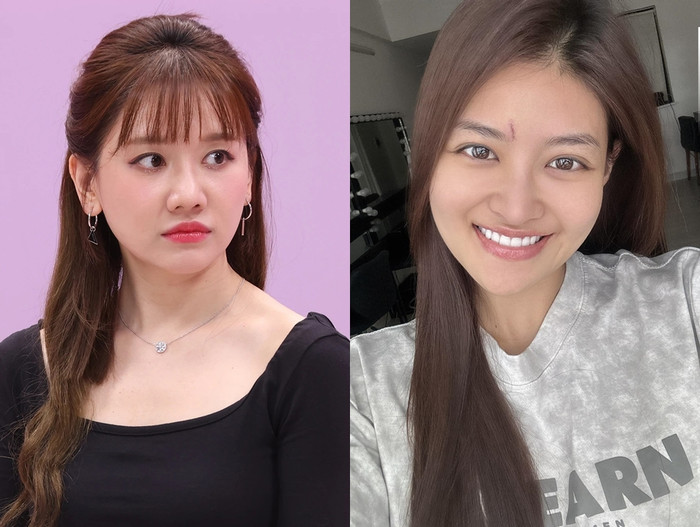 Hari Won nhắn nhủ đến Thùy Anh khi biết nữ diễn viên vừa gặp sự cố, có vết thương ngay giữa trán.