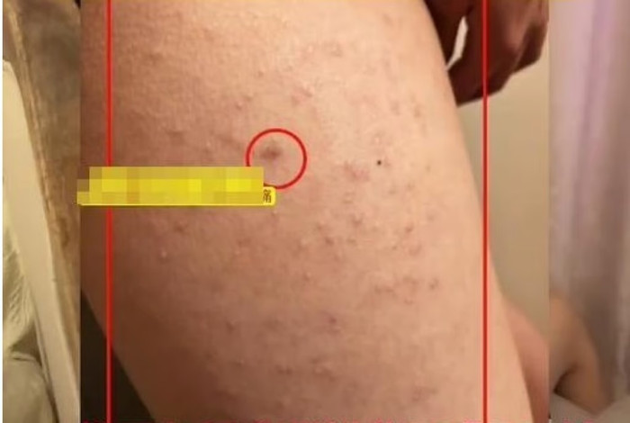 Bé gái tiểu học bị bạn tấn công vào đùi bằng dùi khâu.