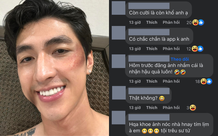 Hình ảnh đầy thương tích được Bình An chia sẻ, netizen có phản ứng gây bão.