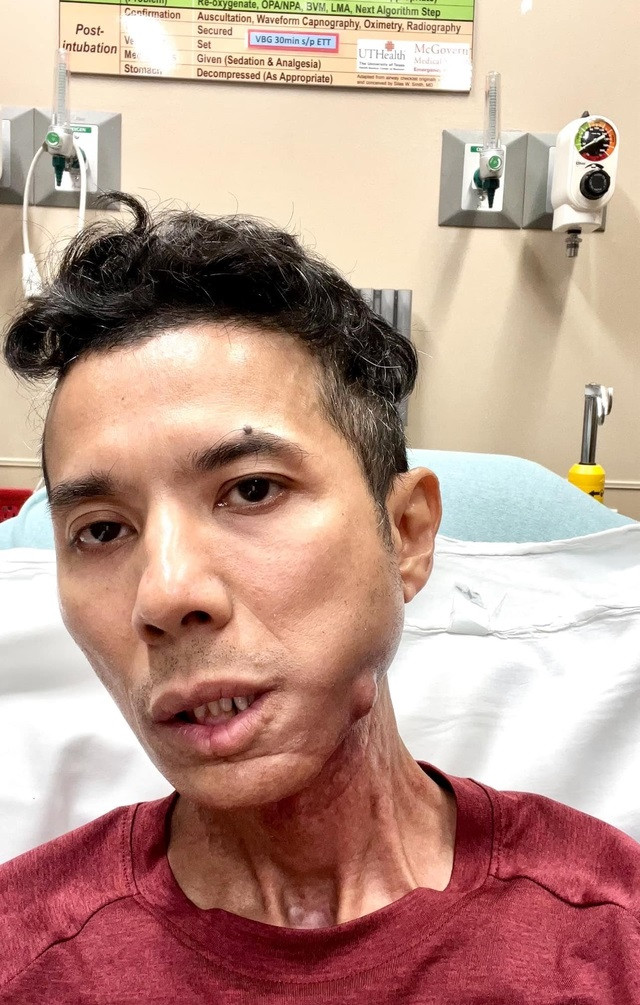 Kasim Hoàng Vũ sụt cân vì bạo bệnh. 