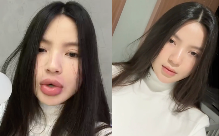 Đôi môi của vợ Quang Hải sưng tấy sau khi tiêm tan filler.