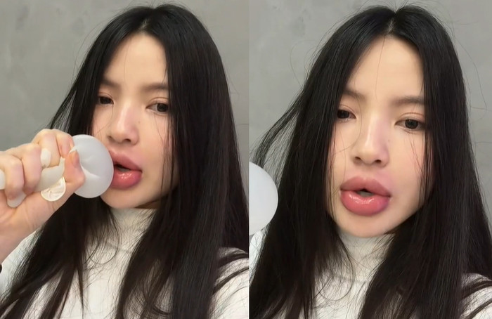 Vợ Quang Hải bị sưng tấy phần môi do filler tồn tài trong cơ thể quá lâu.