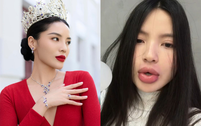 Hoa hậu Kỳ Duyên và vợ Quang Hải làm đẹp giống nhau, vì sao kết quả khác? Ảnh 2