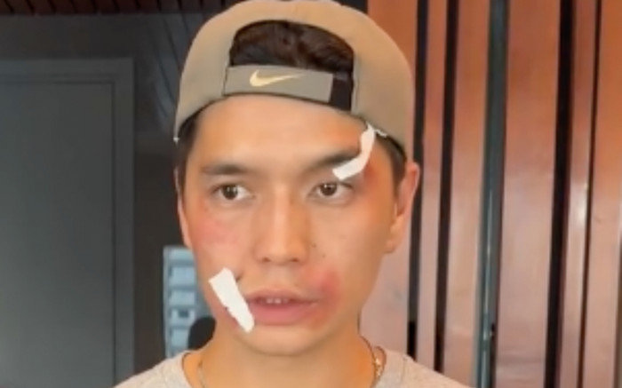 Chồng kém 11 tuổi của Ngô Thanh Vân lộ vết bầm tím khắp khuôn mặt Ảnh 2