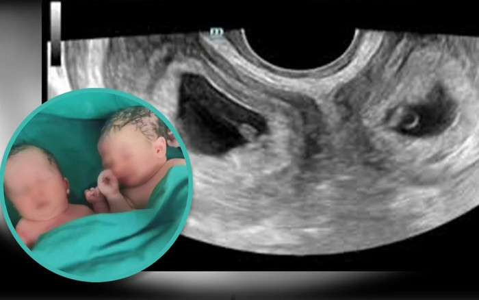 Người phụ nữ có 2 tử cung sinh đôi, điều kỳ diệu khiến bác sĩ ngỡ ngàng Ảnh 2
