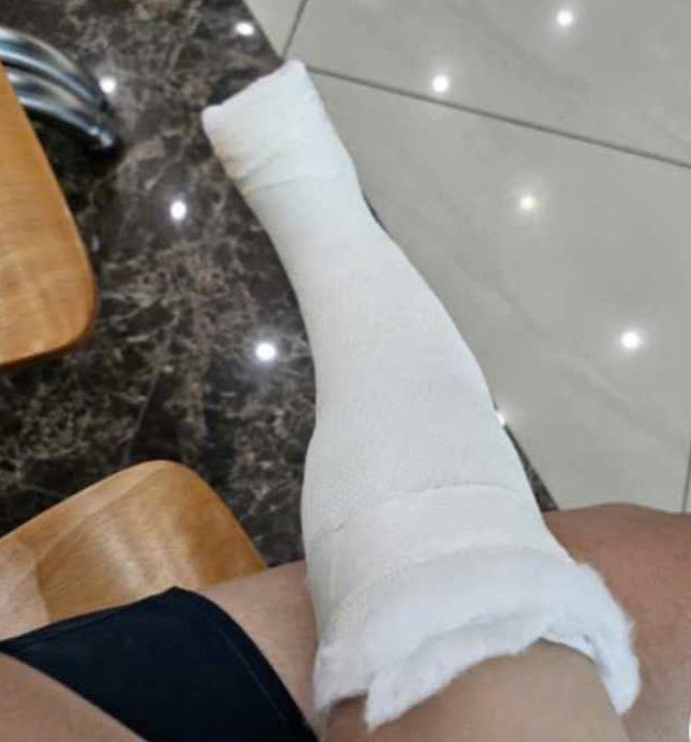 Ngày 14/08, sau khi đưa bé A. đi khám, gia đình phát hiện cháu bị gãy chân.