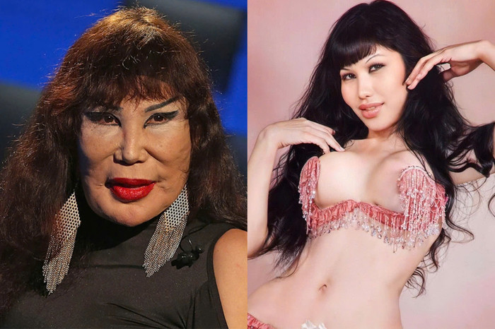 Gương mặt của Lyn May càng lúc càng tệ hơn sau khi bị tiêm dầu vào mặt. 