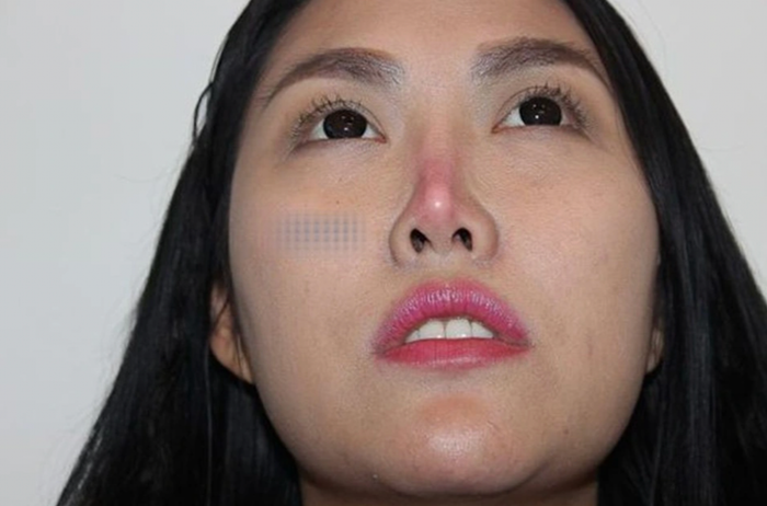 Từng có thời gian, Phi Thanh Vân lộ diện với chiếc mũi biến chứng, bị teo nhỏ, đầu mũi đỏ, có dấu hiệu hoại tử.