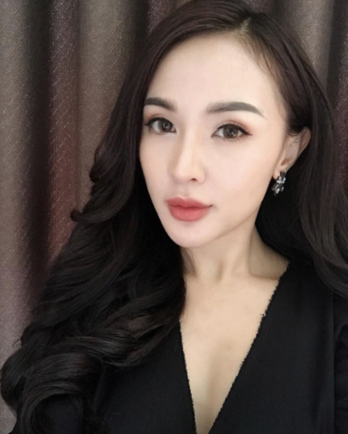 Kelly Nguyễn bị hoại tử khi 'dao kéo' phần cằm, phải trải qua 6 lần thẩm mỹ.