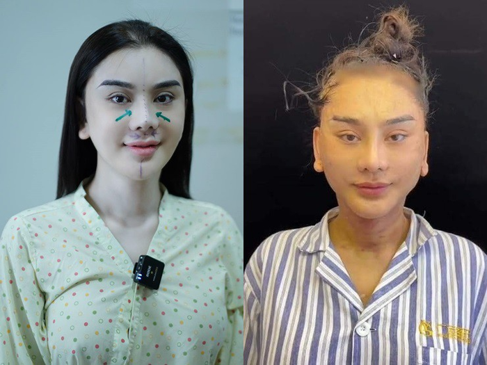 Lâm Khánh Chi muốn lấy lại nhan sắc ở tuổi 25 nên quyết định phẫu thuật thẩm mỹ căng da mặt. 